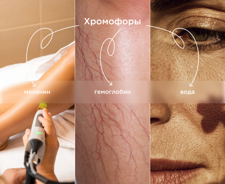 Вещества в коже, поглащающие лазерное излучение.
