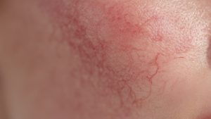 Как возраст и состояние ЖКТ влияют на развитие купероза и розацеа?