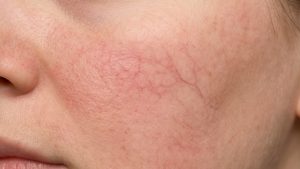 Купероз на лице: почему появляются сосуды и как их убрать