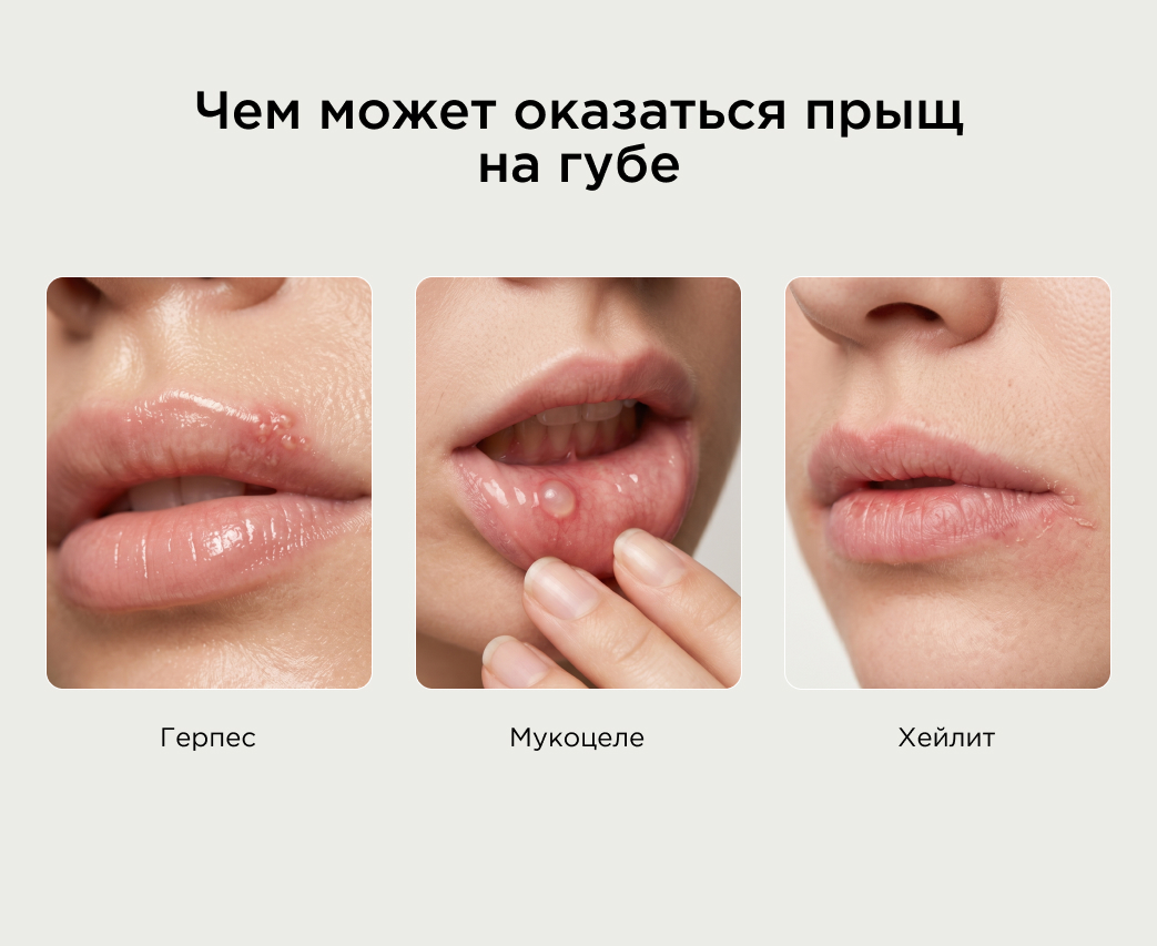 чем может оказаться прыщ на губе