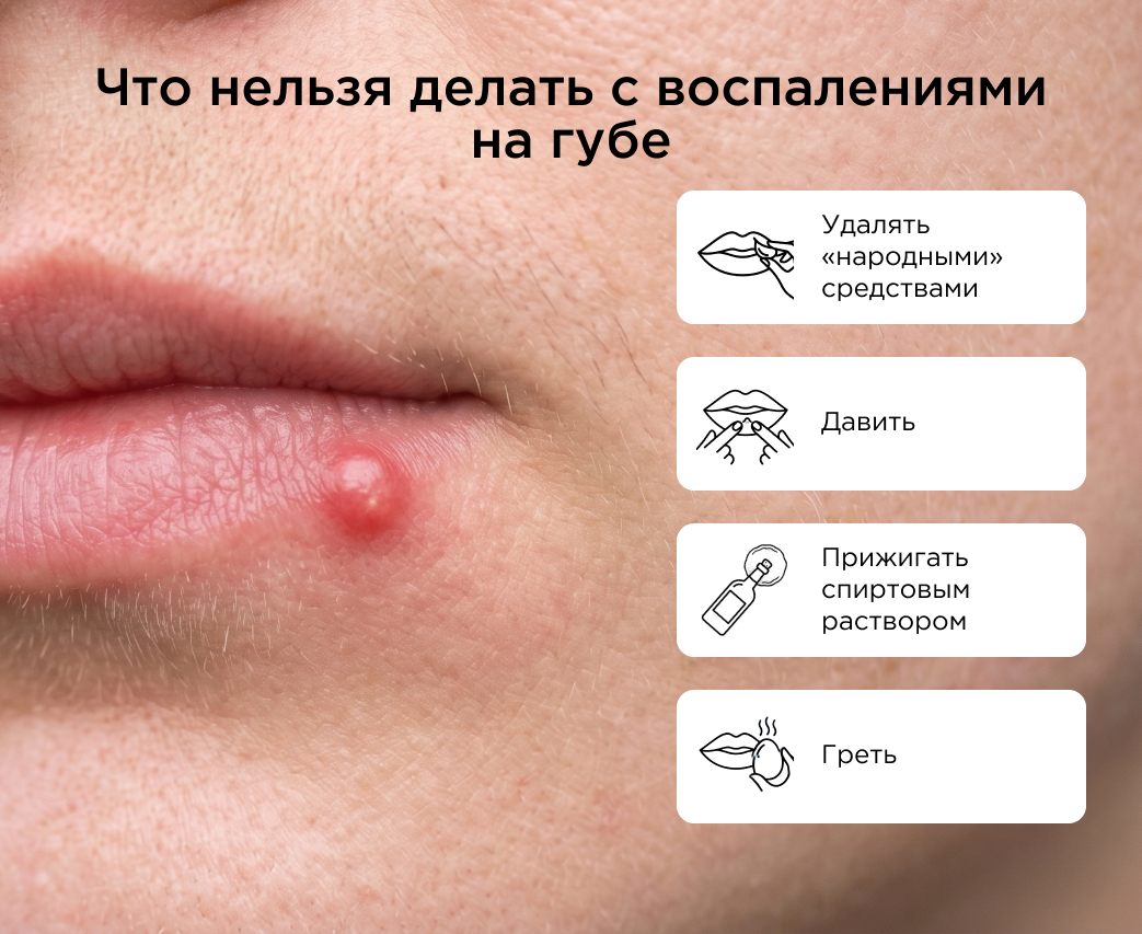 Что нельзя делать с воспалениями на губе