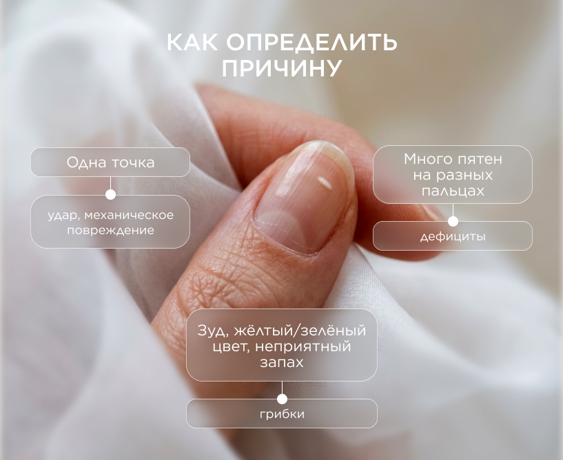 Как определить причину белых пятен на ногтях