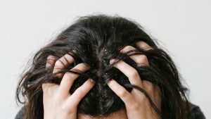 Как избавиться от перхоти. Поможет ли шампунь и когда бежать к врачу