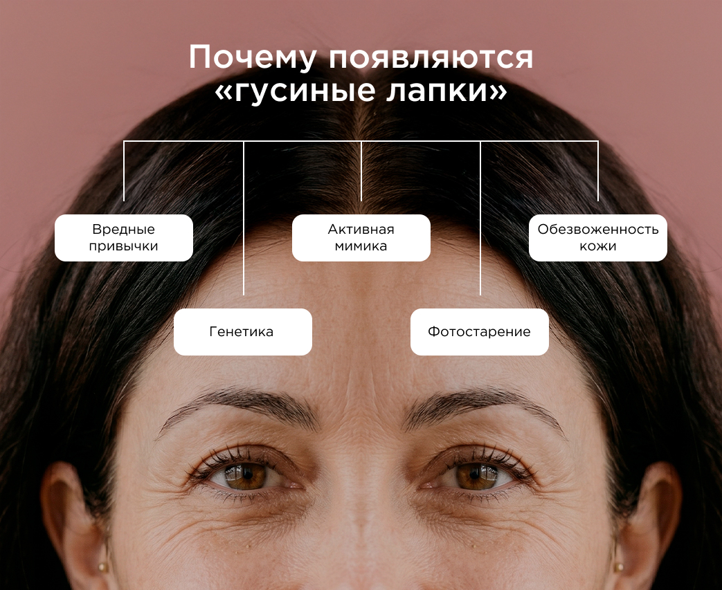 Почему появляются «гусиные лапки»