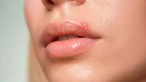 Из-за чего появляются прыщи на губах и как от них избавиться