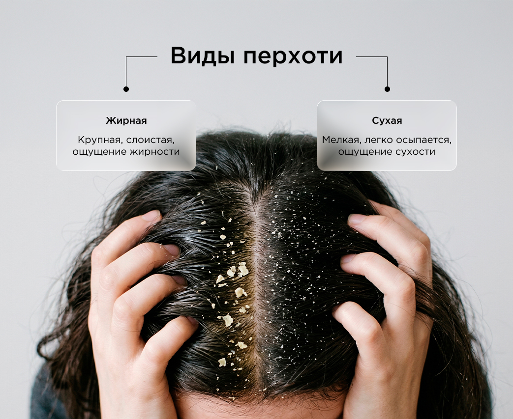 виды перхоти
