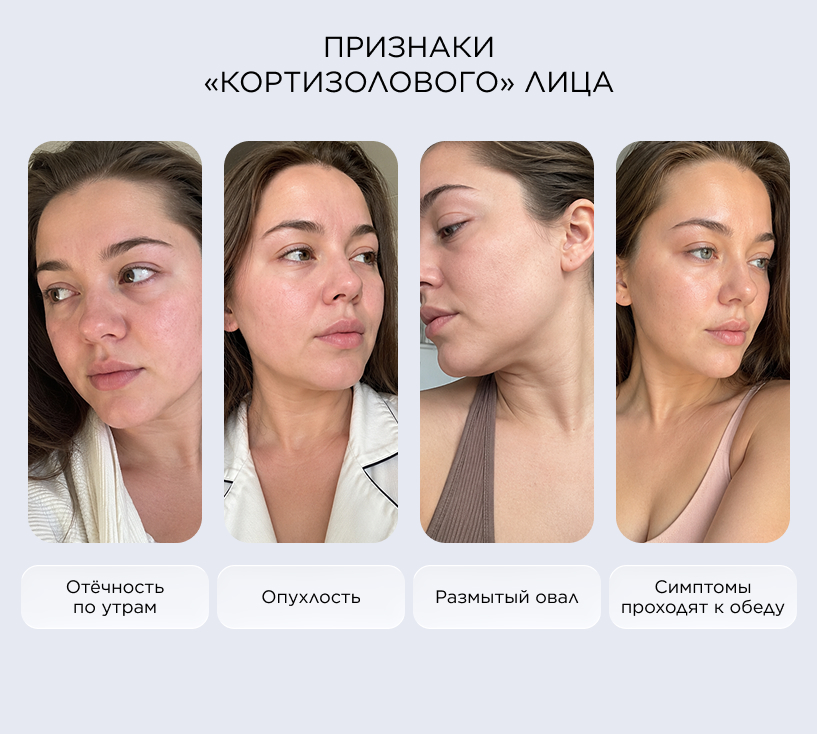 Признаки «кортизолового» лица
