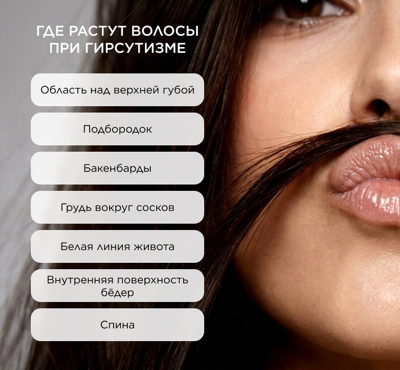 Где растут волосы при гирсутизме