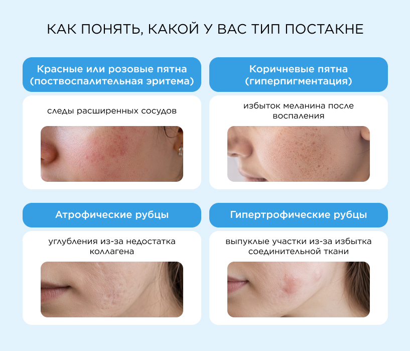 Как понять, какой у вас тип постакне