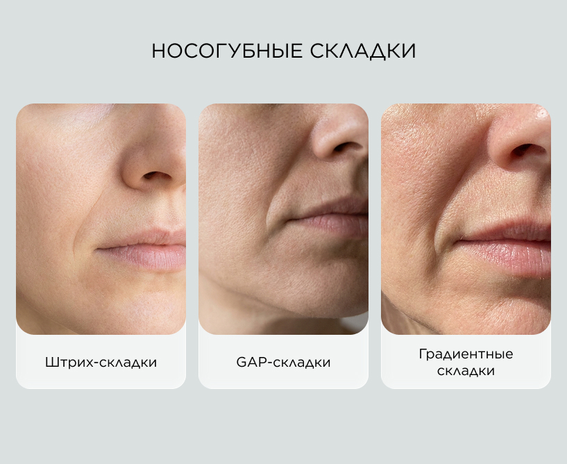Носогубные складки