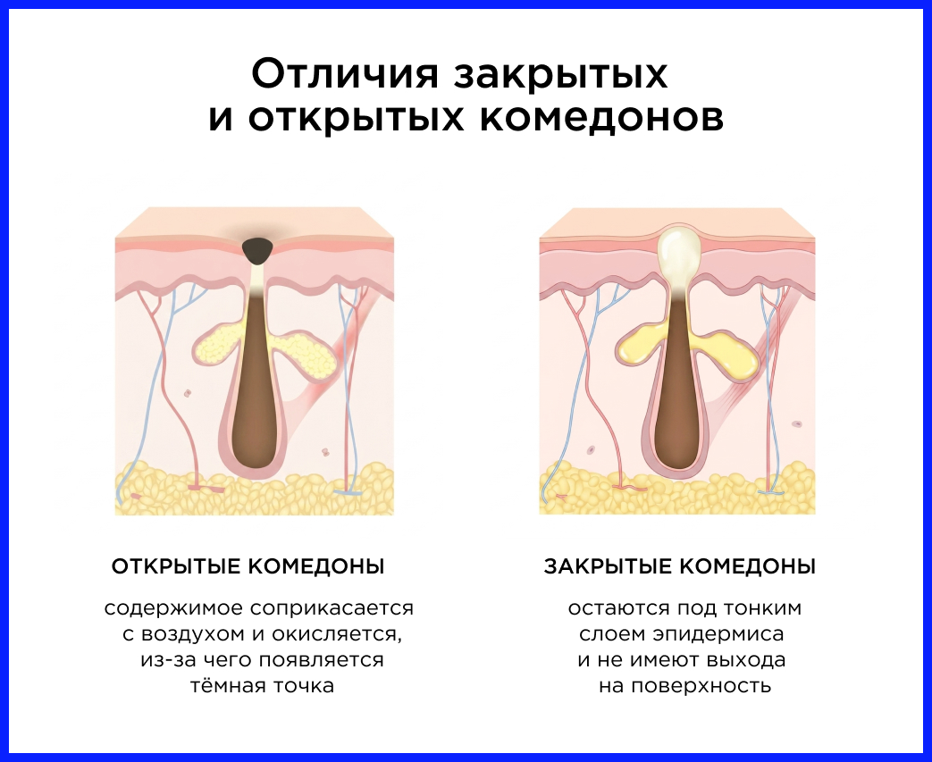 Отличия закрытых и открытых комедонов