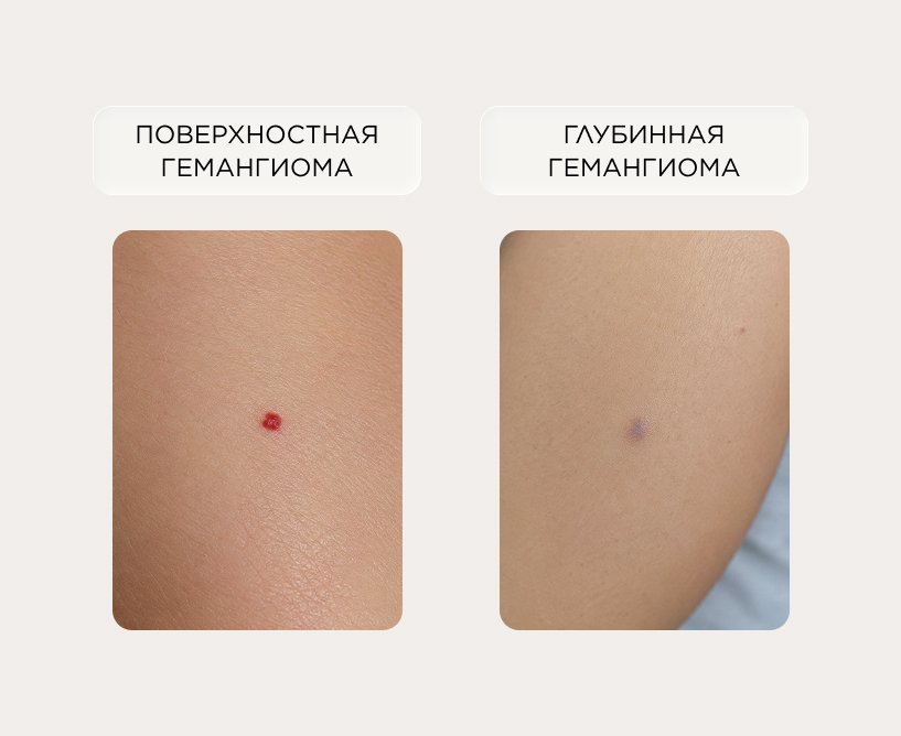 поверхностная и глубинная гемангиома
