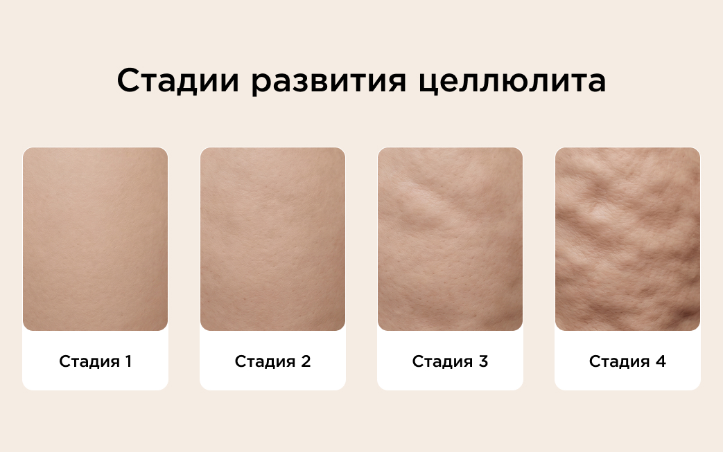 Стадии развития целлюлита