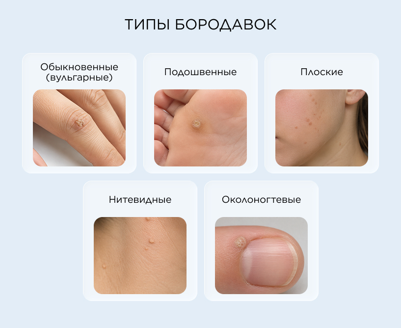 Виды бородавок