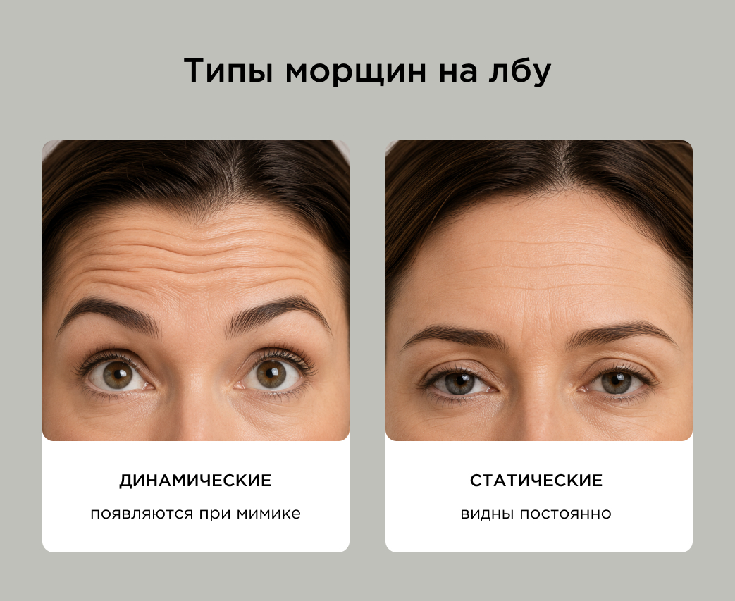 Какими бывают морщины