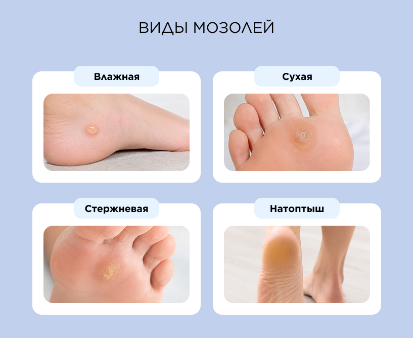 Основные виды мозолей