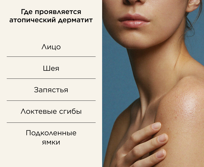 Где проявляется атопический дерматит