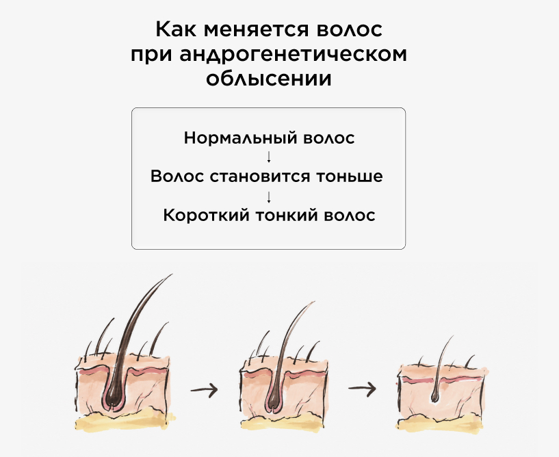 Как меняется волос при андрогенетическом облысении