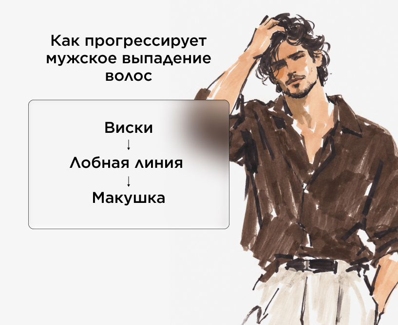 Как прогрессирует мужское выпадение волос