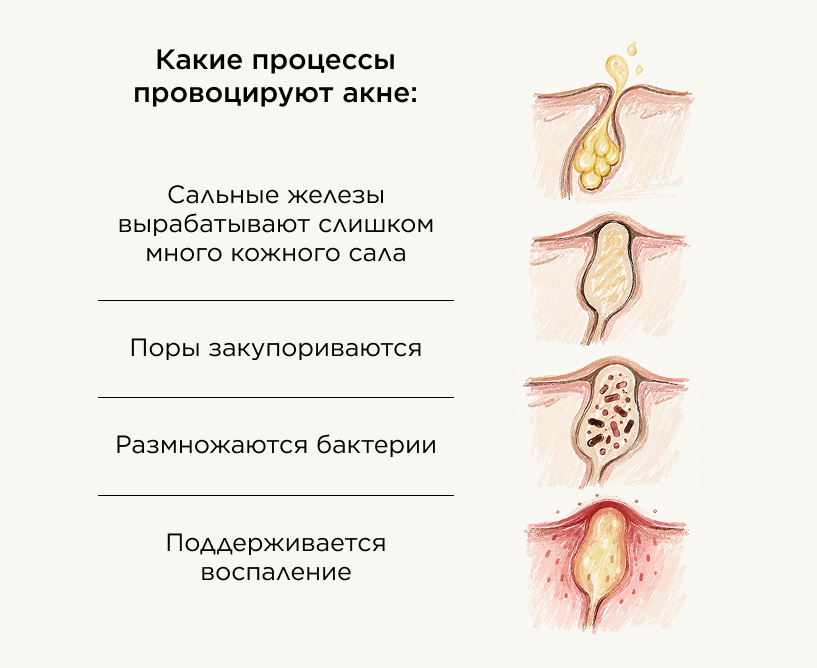 Какие процессы провоцируют акне