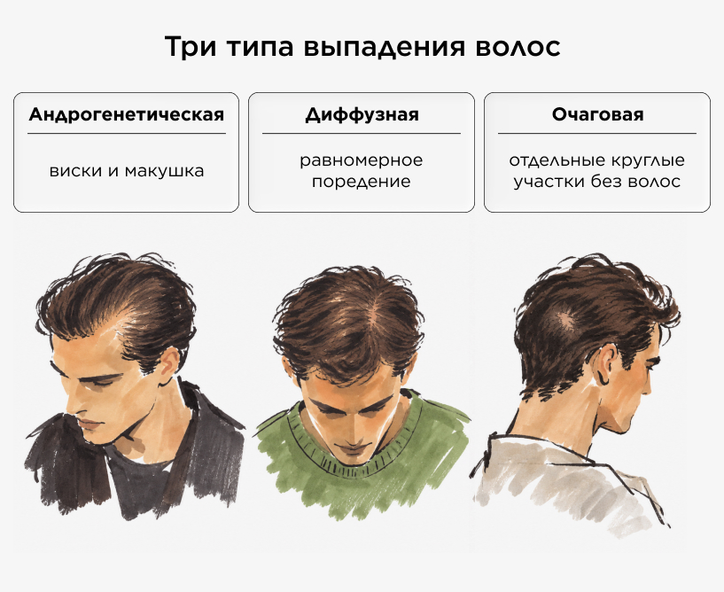 Три типа выпадения волос