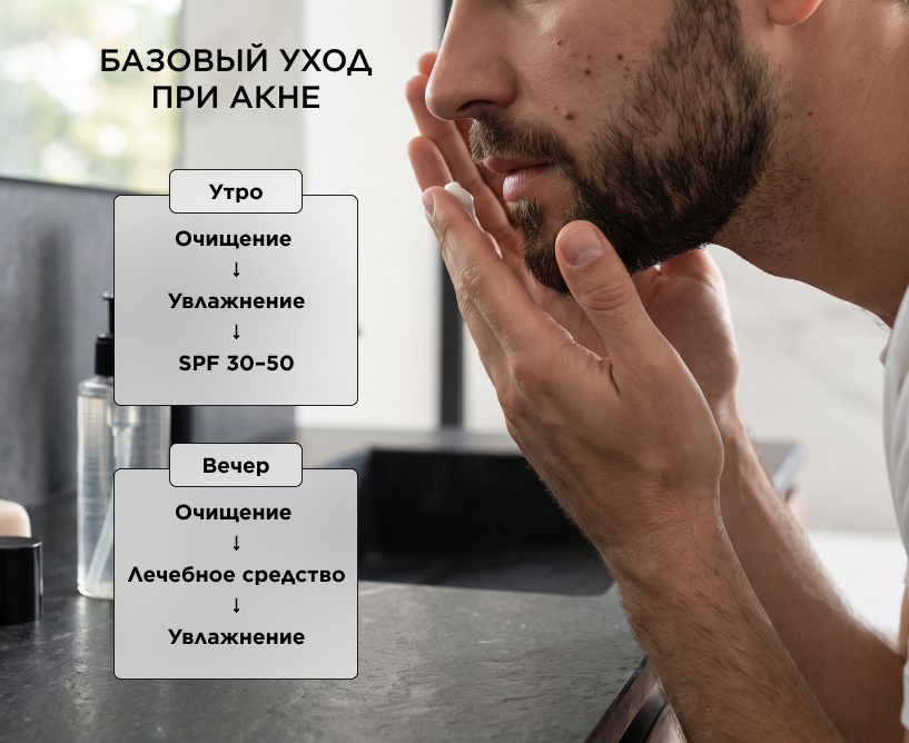 Как ухаживать за проблемной кожей с акне