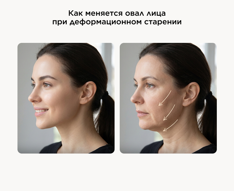 Что такое деформационный тип старения и как он формируется