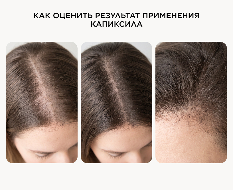 Как оценивать результат и чего ждать от применения капиксила