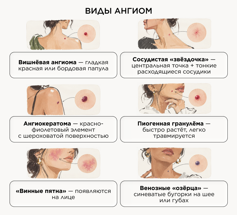 Какие виды ангиом существуют